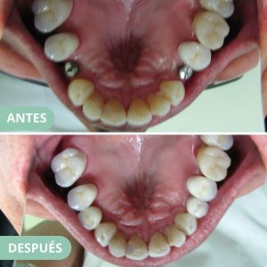 caso corona sobre implante 2
