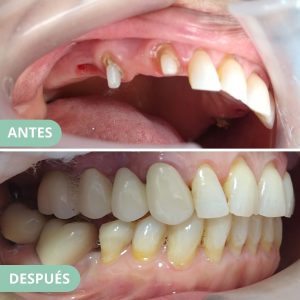 caso corona sobre implante 4