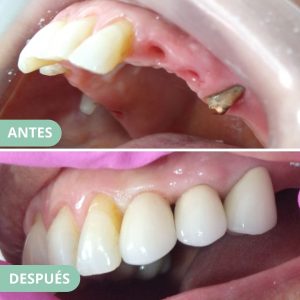caso corona sobre implante 5